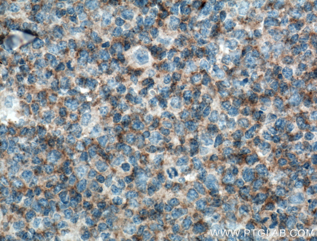 IHC staining of human tonsillitis using 66576-1-Ig (same clone as 66576-1-PBS)