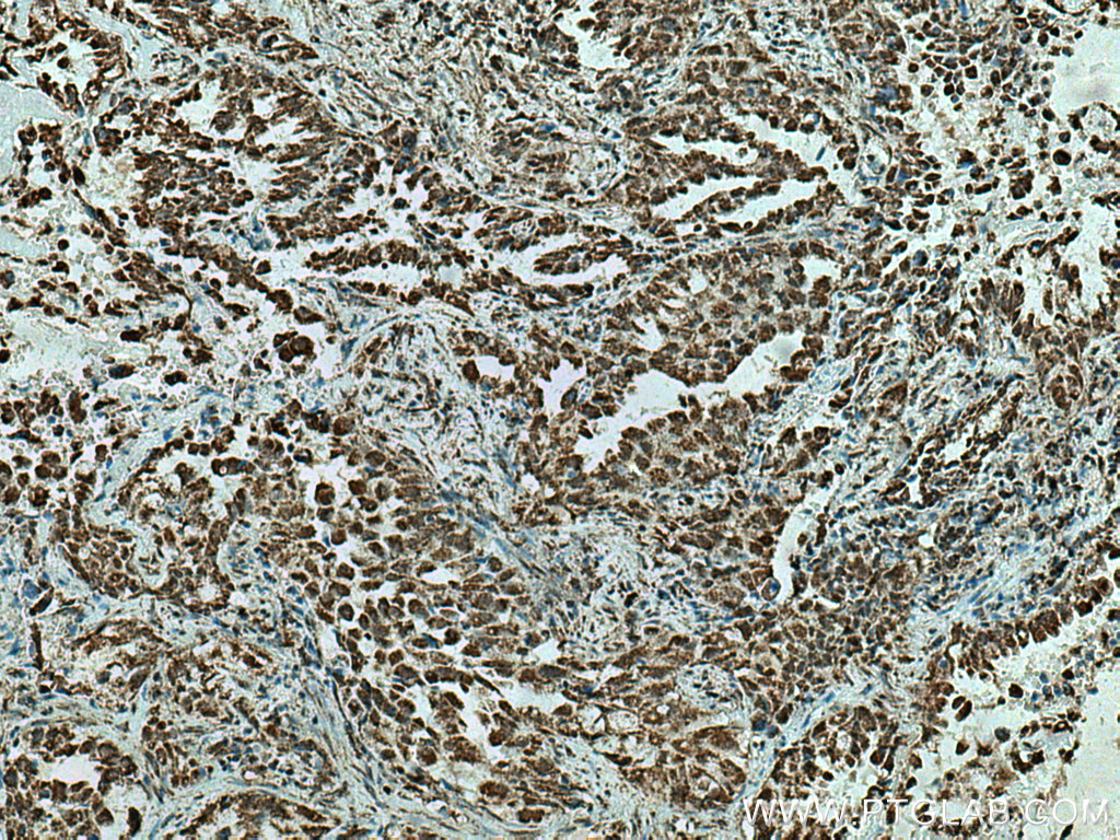 IHC staining of human lung cancer using 29219-1-AP (same clone as 29219-1-PBS)