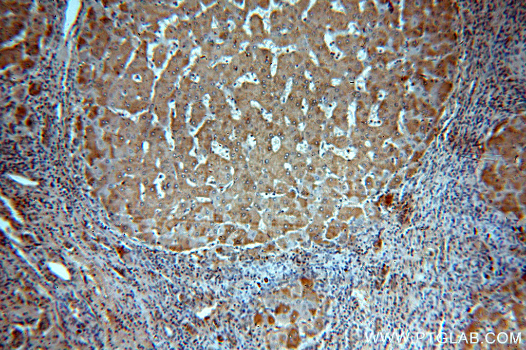 IHC staining of human hepatocirrhosis using 13725-1-AP