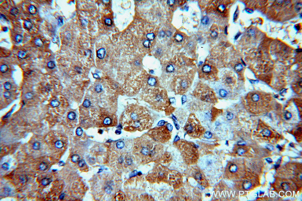 IHC staining of human hepatocirrhosis using 13725-1-AP