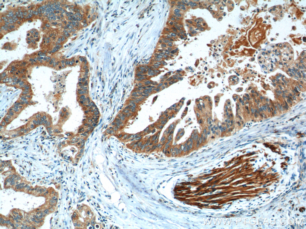 IHC staining of human pancreas cancer using 14787-1-AP