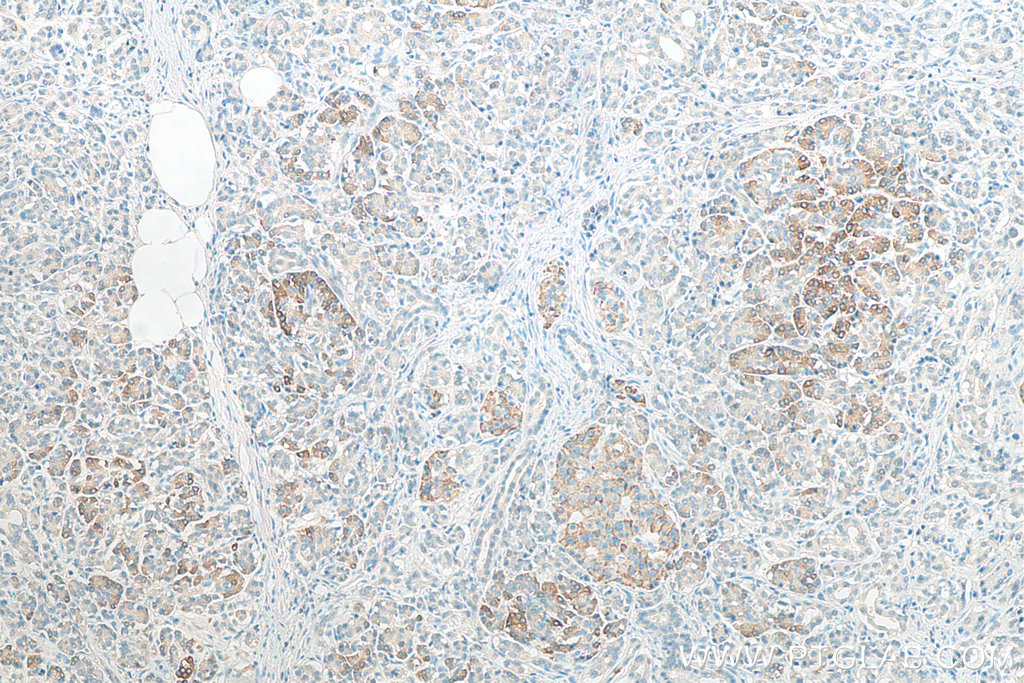 IHC staining of human pancreas cancer using 67861-1-Ig (same clone as 67861-1-PBS)