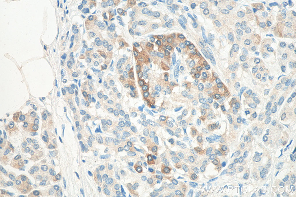 IHC staining of human pancreas cancer using 67861-1-Ig