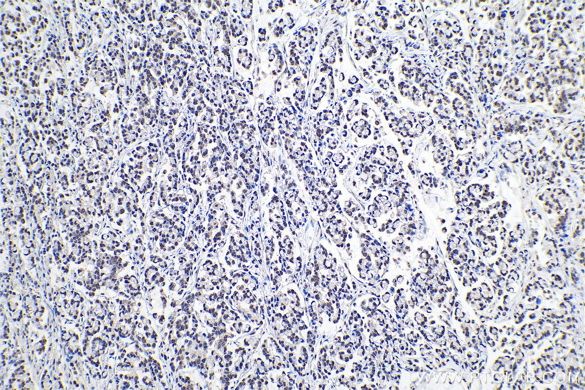 IHC staining of human colon cancer using 10241-2-AP