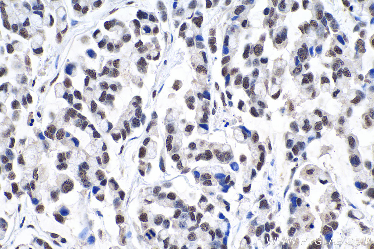 IHC staining of human colon cancer using 10241-2-AP