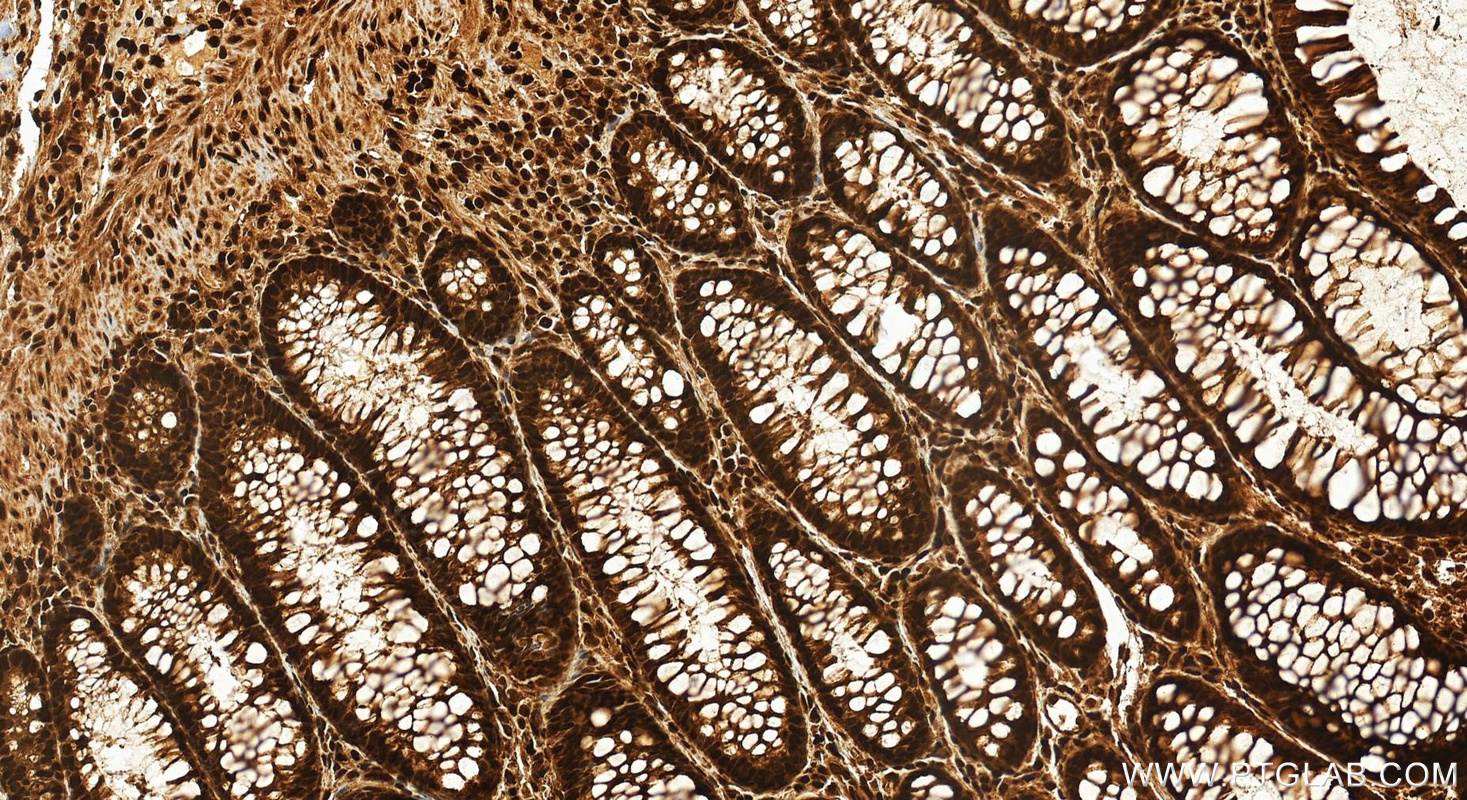 IHC staining of human colon cancer using 11650-2-AP