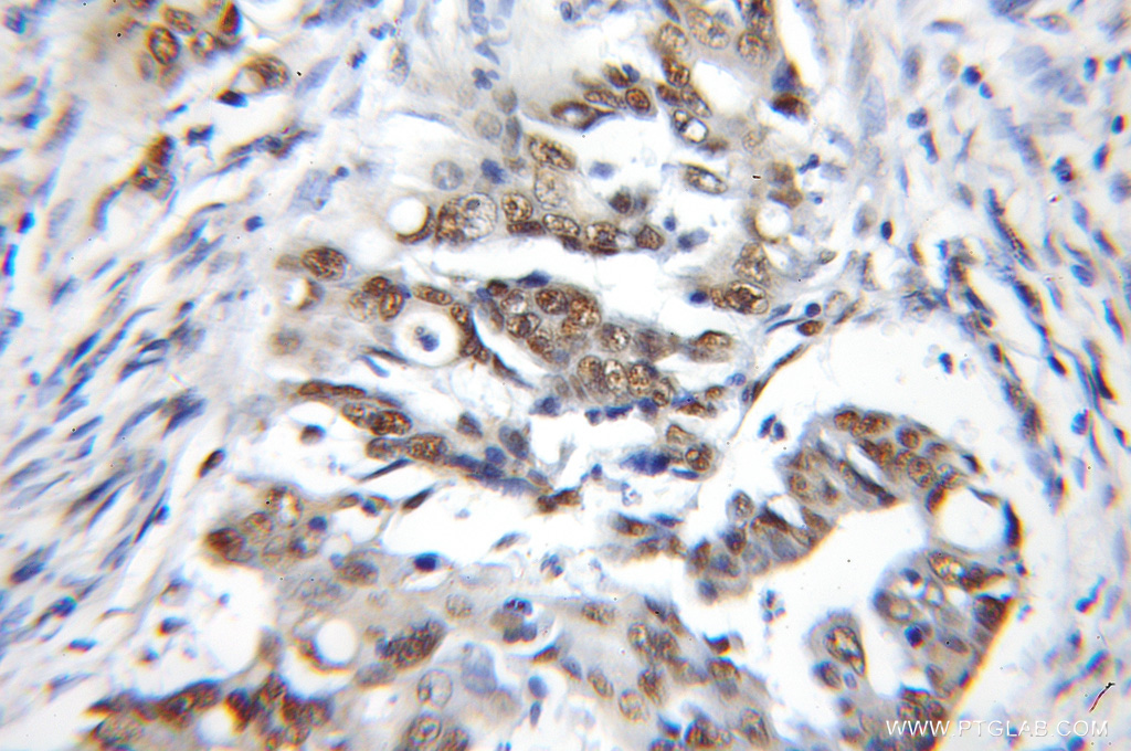 IHC staining of human colon cancer using 11650-2-AP
