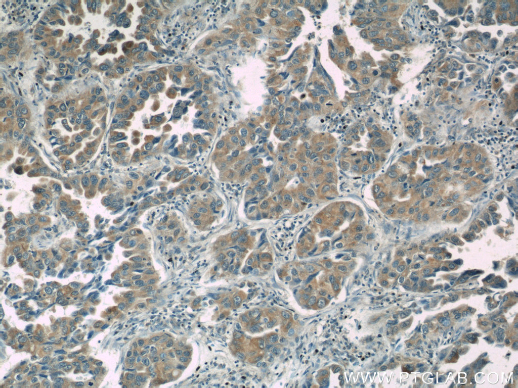 IHC staining of human lung cancer using 22293-1-AP