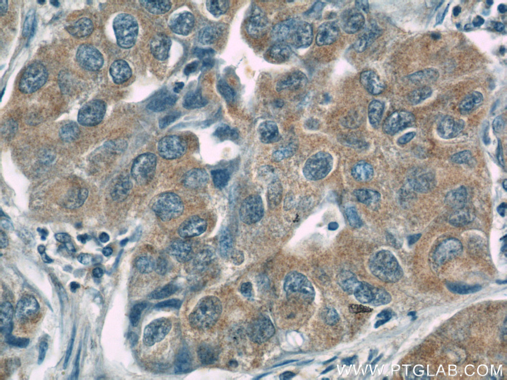 IHC staining of human lung cancer using 22293-1-AP