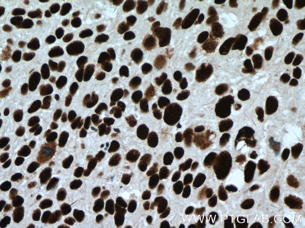 IHC staining of human cervical cancer using 66497-1-Ig