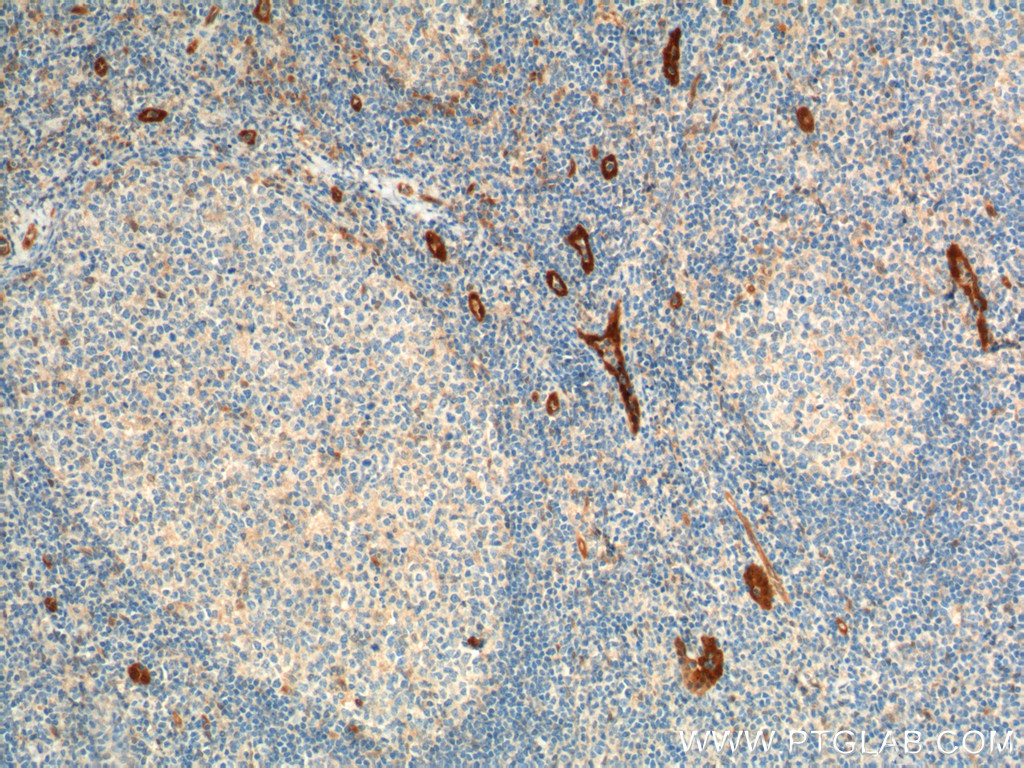 IHC staining of human tonsillitis using 60046-1-Ig