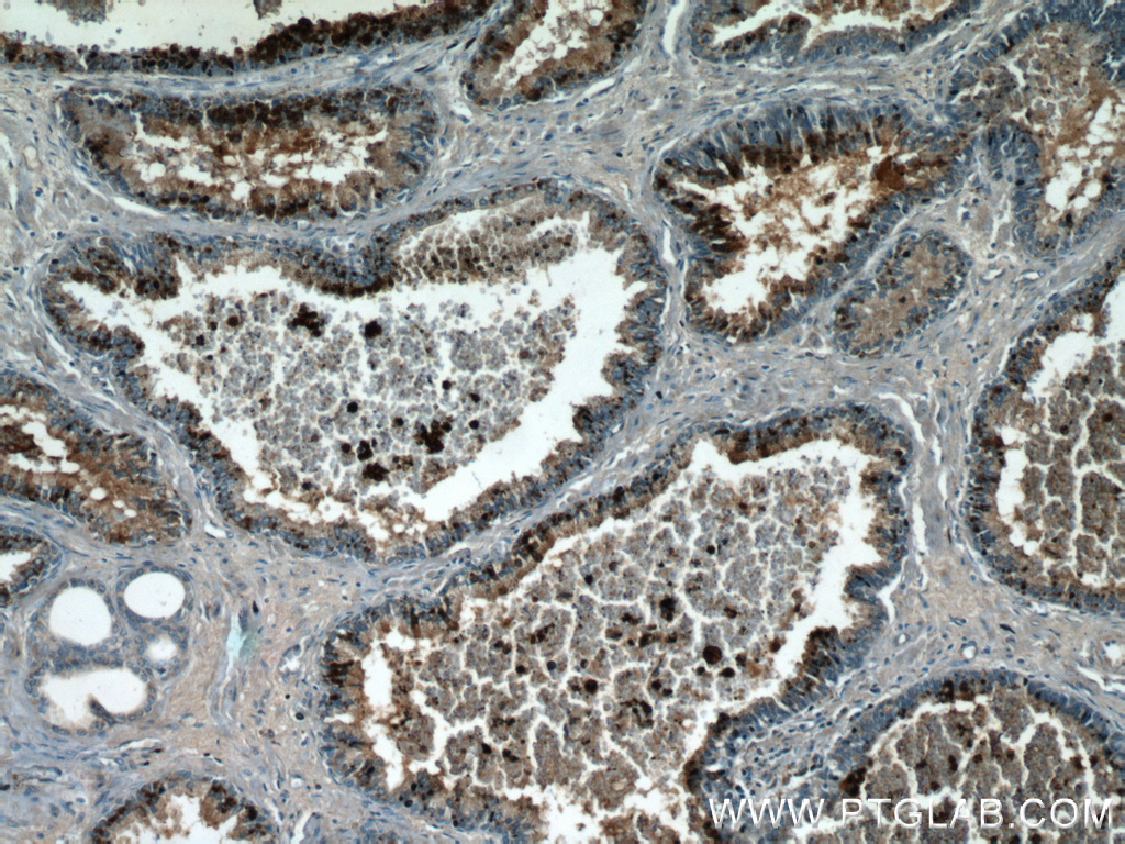 IHC staining of human prostate hyperplasia using 21390-1-AP