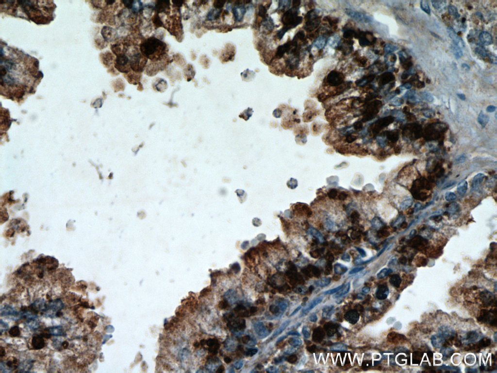 IHC staining of human prostate hyperplasia using 21390-1-AP