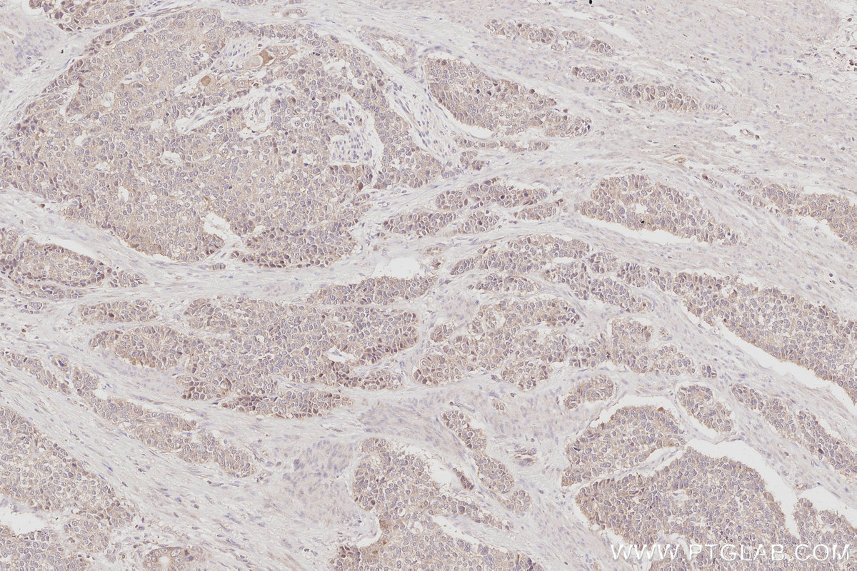 IHC staining of human stomach cancer using 26013-1-AP IHC staining of human stomach cancer using 26013-1-AP