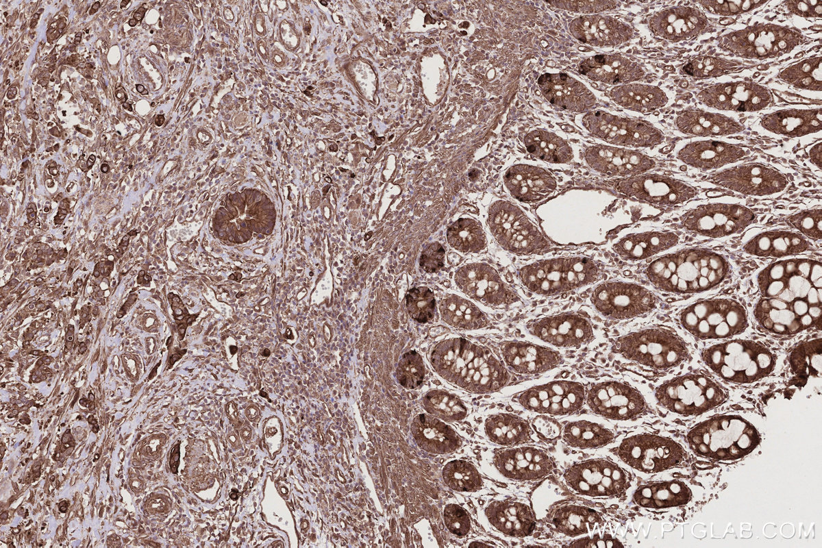 IHC staining of human rectal cancer using 11094-2-AP IHC staining of human rectal cancer using 11094-2-AP