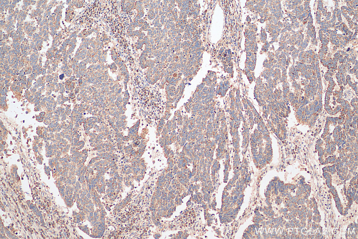 IHC staining of human ovary tumor using 20465-1-AP