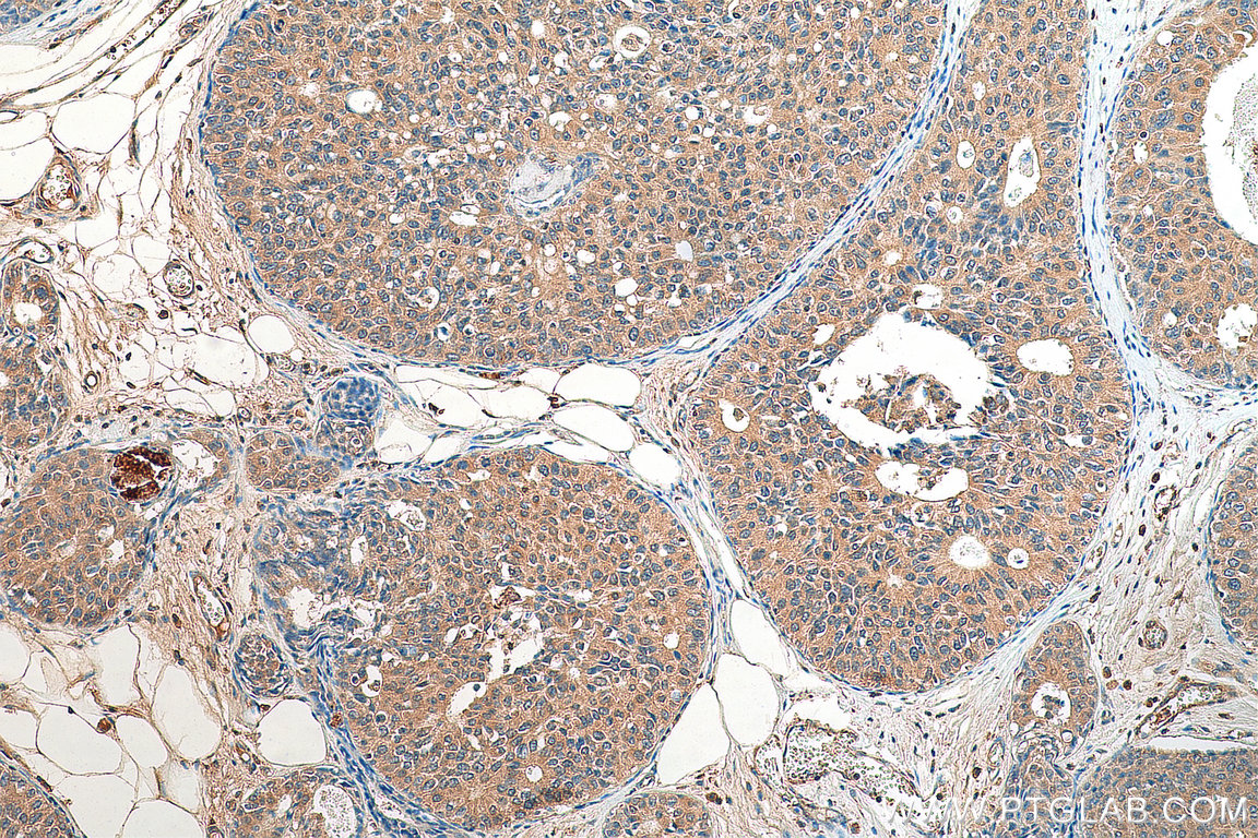 IHC staining of human breast cancer using 22770-1-AP