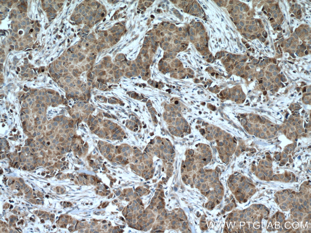 IHC staining of human breast cancer using 28152-1-AP