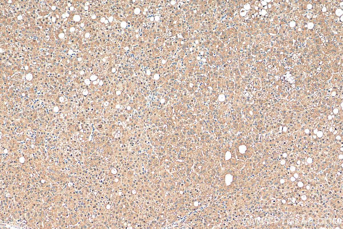 IHC staining of human liver cancer using 24689-1-AP