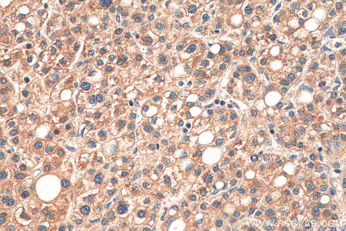 IHC staining of human liver cancer using 14216-1-AP
