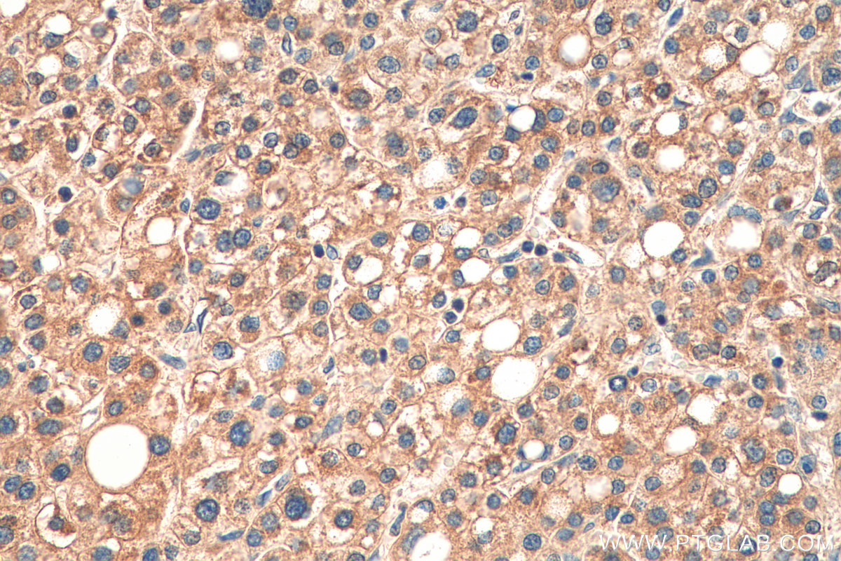 IHC staining of human liver cancer using 14216-1-AP