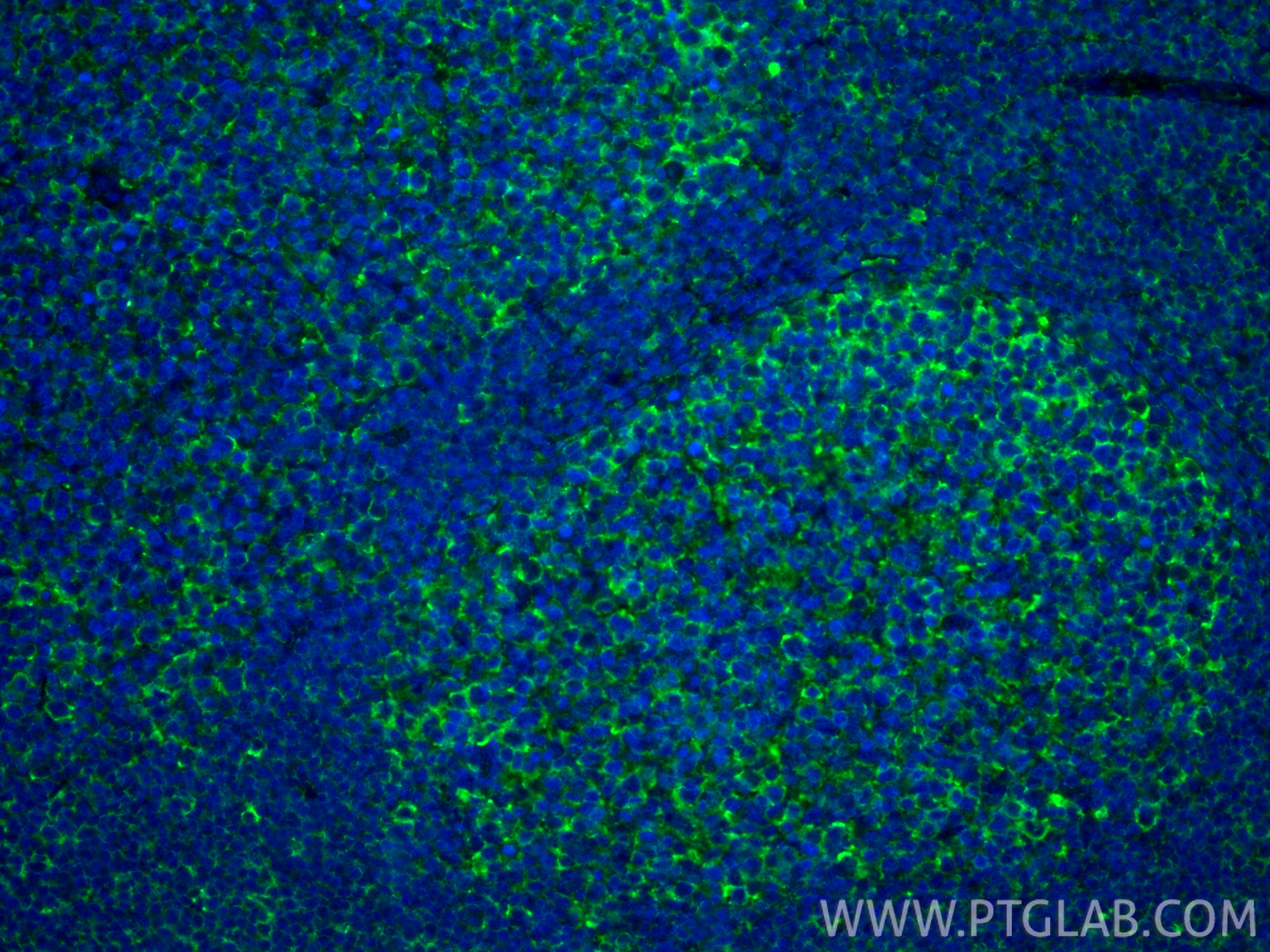 IF Staining of human tonsillitis using 22303-1-AP IF Staining of human tonsillitis using 22303-1-AP