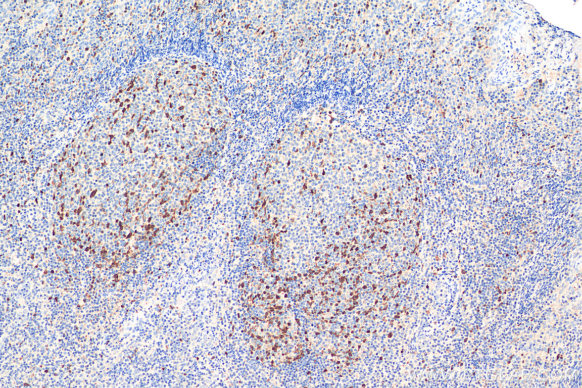 IHC staining of human tonsillitis using 18202-1-AP