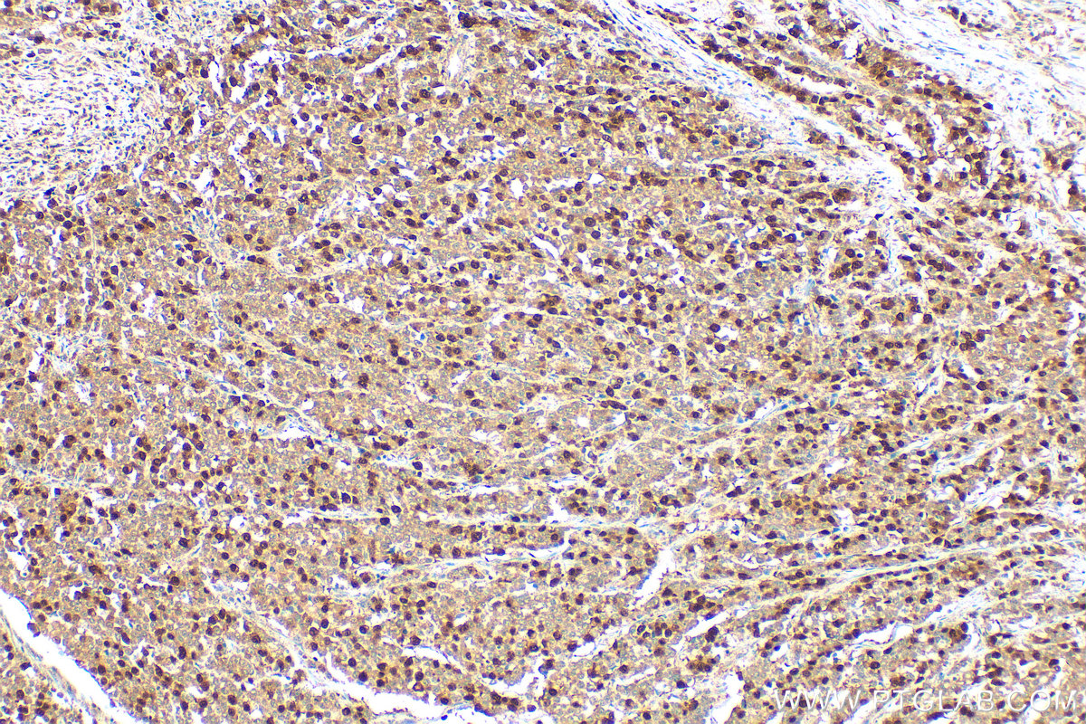 Immunohistochemical analysis of paraffin-embedded human colon cancer tissue slide using 18202-1-AP (Cyclin A2 antibody) at dilution of 1:1000 (under 10x lens). Heat mediated antigen retrieval with Tris-EDTA buffer (pH 9.0). IHC staining of human colon cancer using 18202-1-AP