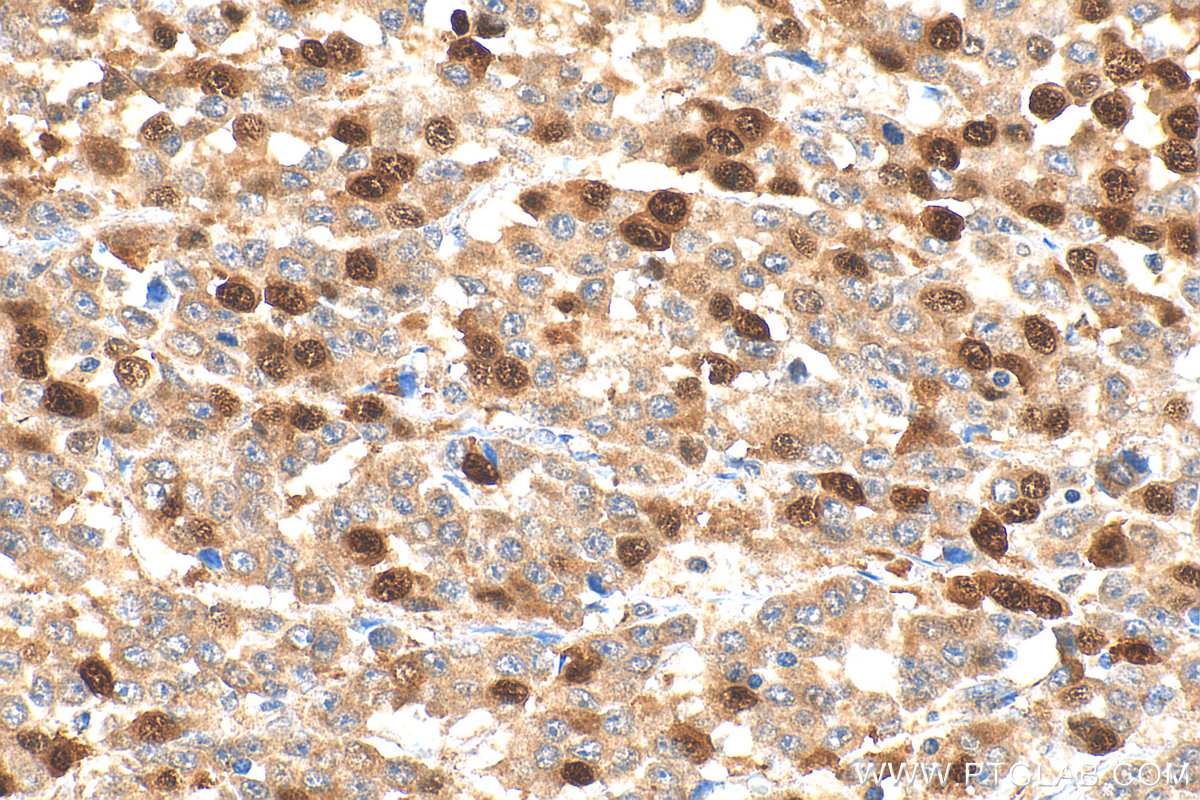 Immunohistochemical analysis of paraffin-embedded human colon cancer tissue slide using 18202-1-AP (Cyclin A2 antibody) at dilution of 1:1000 (under 40x lens). Heat mediated antigen retrieval with Tris-EDTA buffer (pH 9.0). IHC staining of human colon cancer using 18202-1-AP