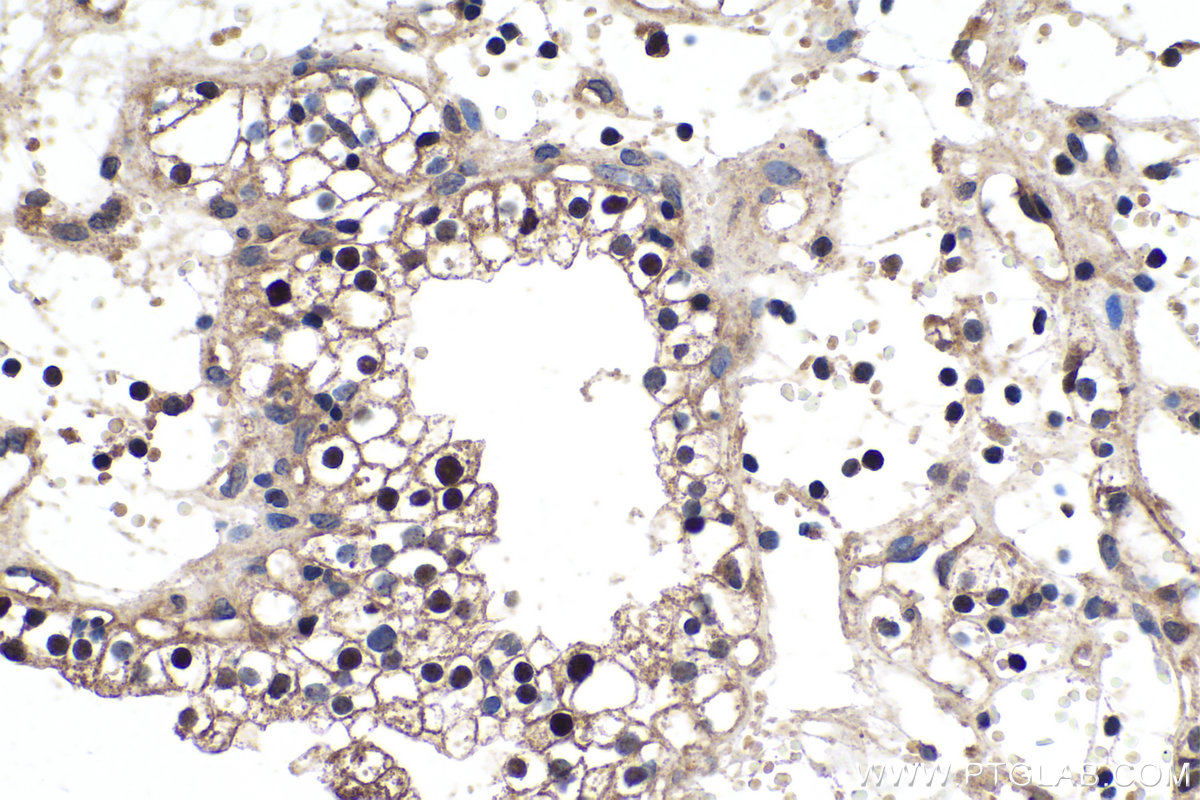 IHC staining of human renal cell carcinoma using 10934-1-AP