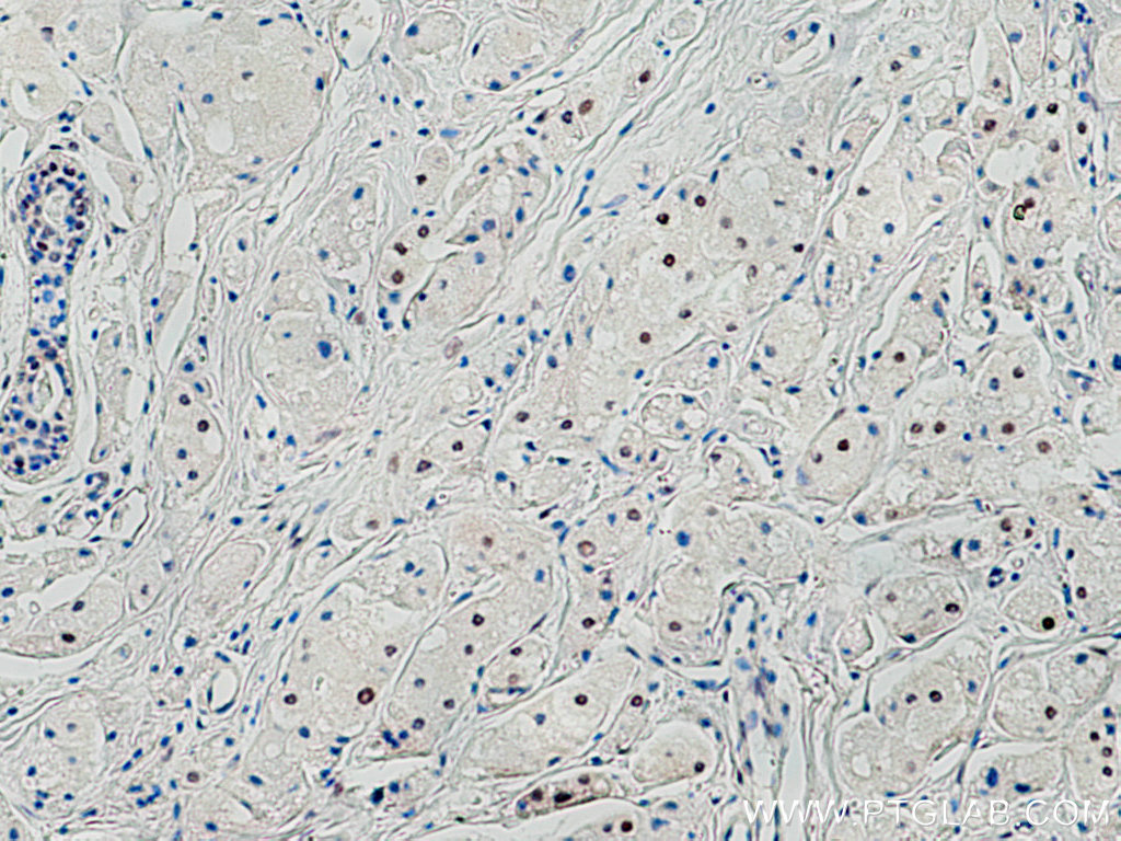 IHC staining of human breast cancer using 11935-1-AP
