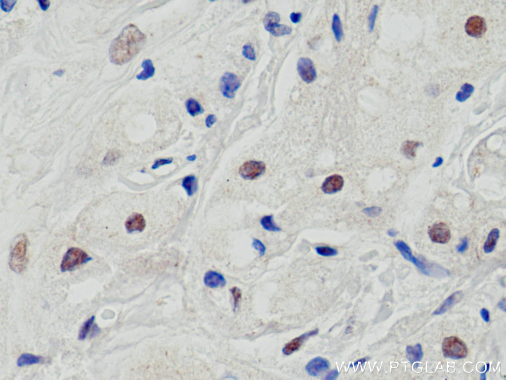 IHC staining of human breast cancer using 11935-1-AP