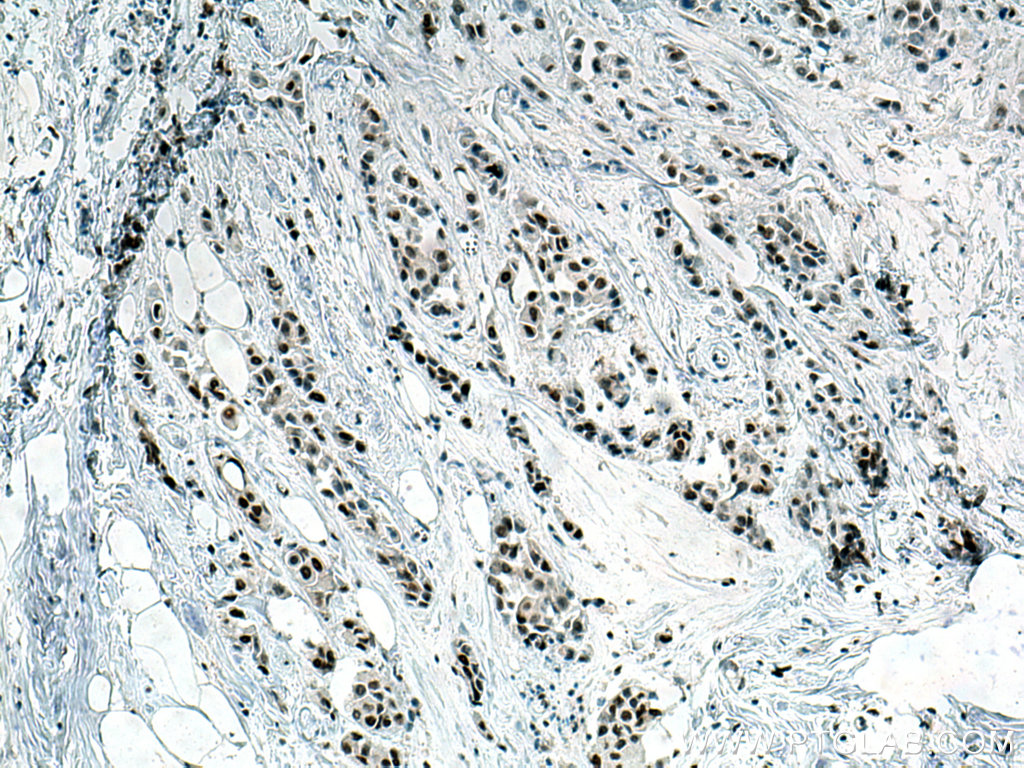 IHC staining of human breast cancer using 10718-1-AP