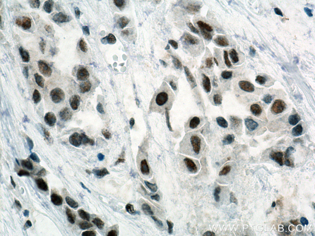 IHC staining of human breast cancer using 10718-1-AP