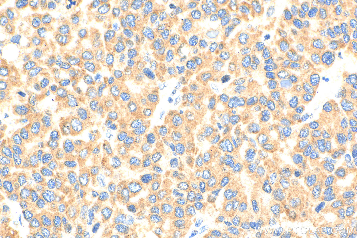 IHC staining of human liver cancer using 16154-1-AP
