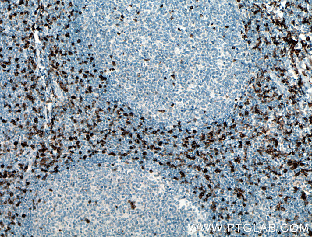 IHC staining of human tonsillitis using 17476-1-AP