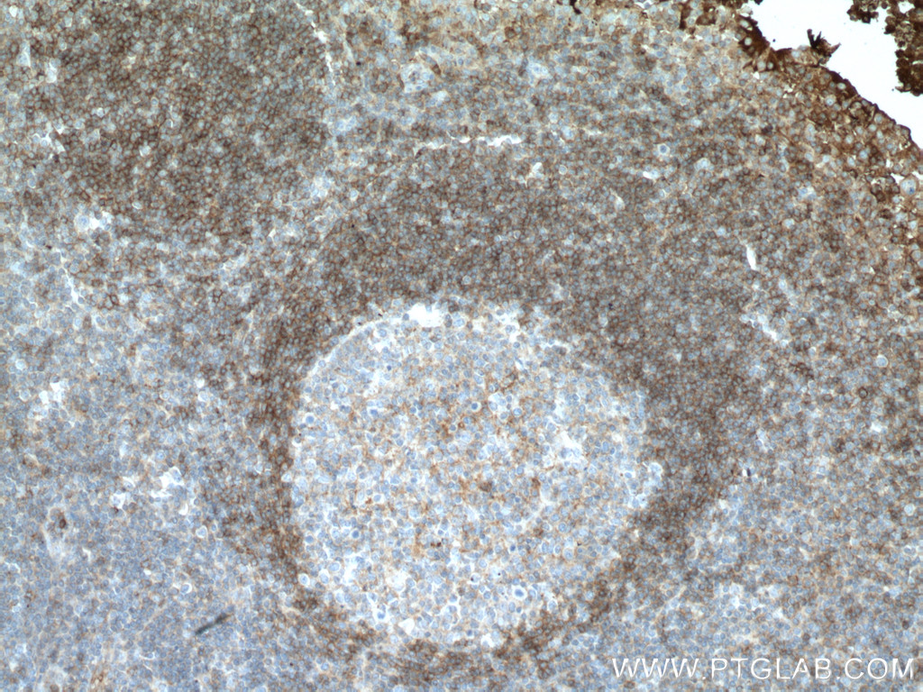 IHC staining of human tonsillitis using 66801-1-Ig (same clone as 66801-1-PBS)