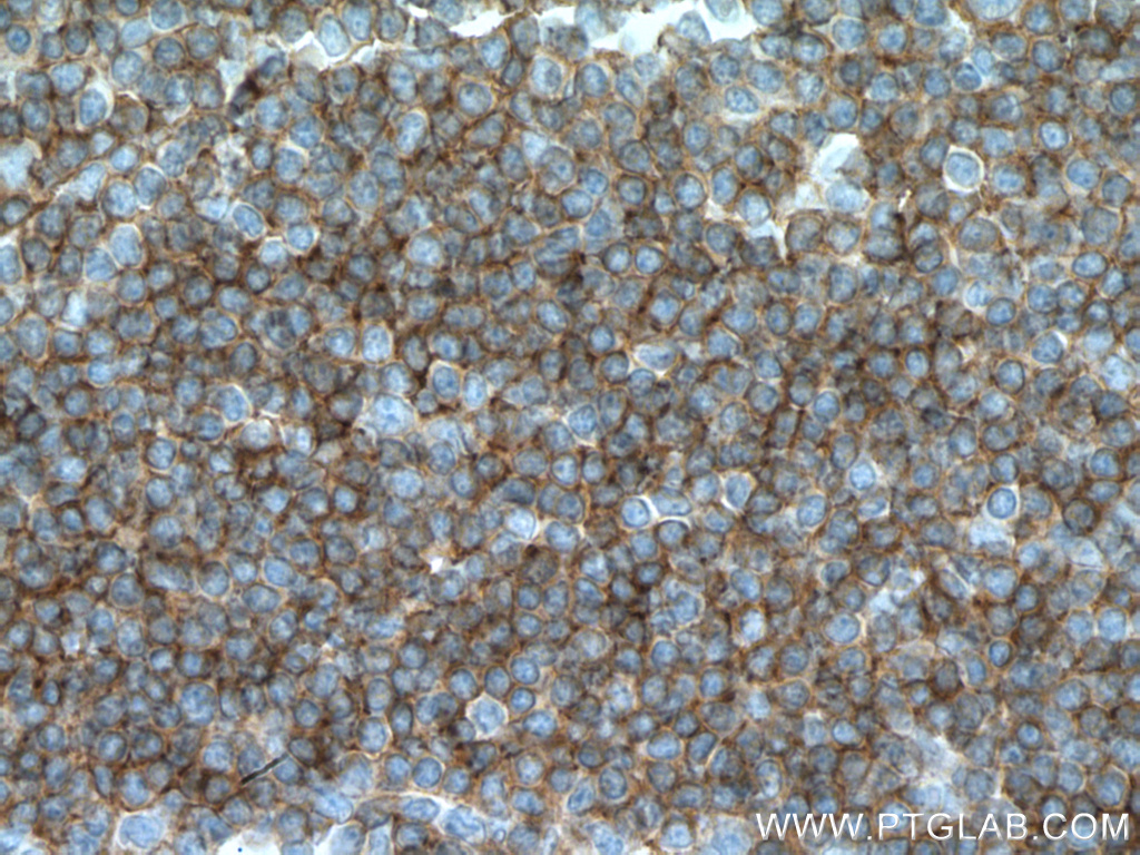 IHC staining of human tonsillitis using 66801-1-Ig (same clone as 66801-1-PBS)