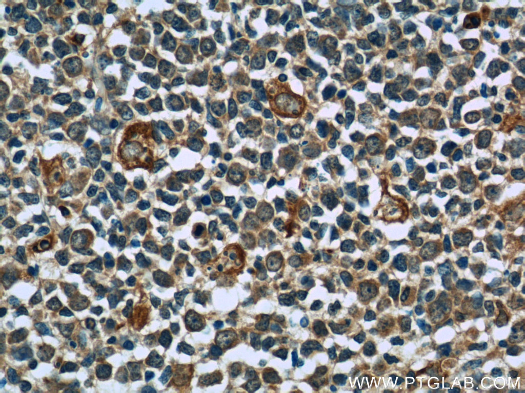 IHC staining of human tonsillitis using 55425-1-AP