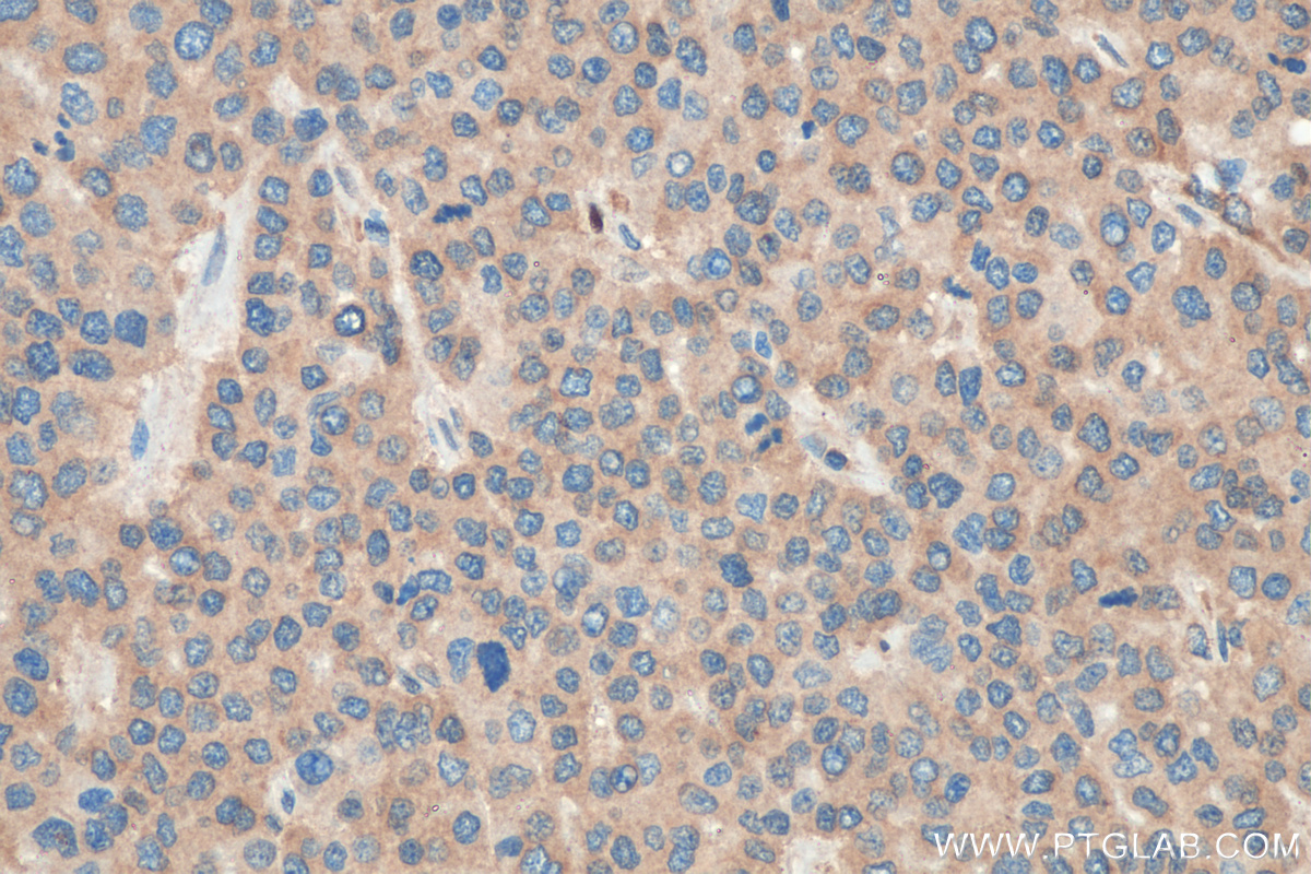 IHC staining of human liver cancer using 21524-1-AP