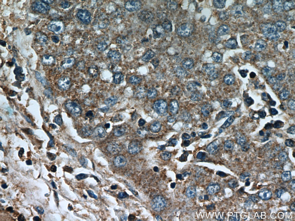 IHC staining of human liver cancer using 21524-1-AP