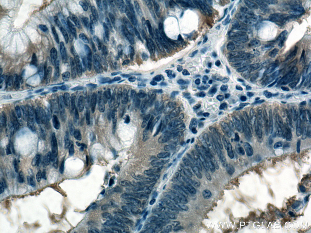 IHC staining of human colon cancer using 11603-1-AP