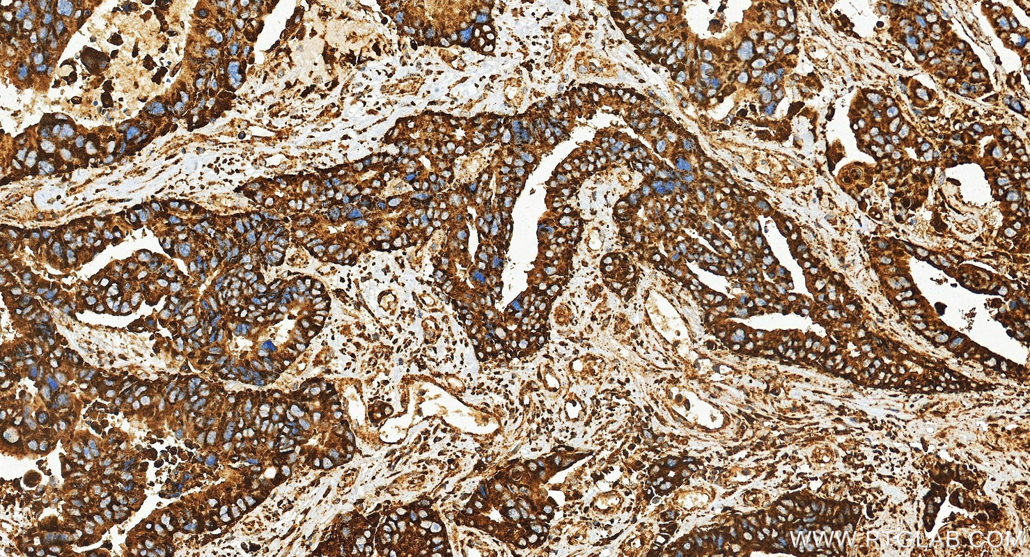 IHC staining of human colon cancer using 21997-1-AP