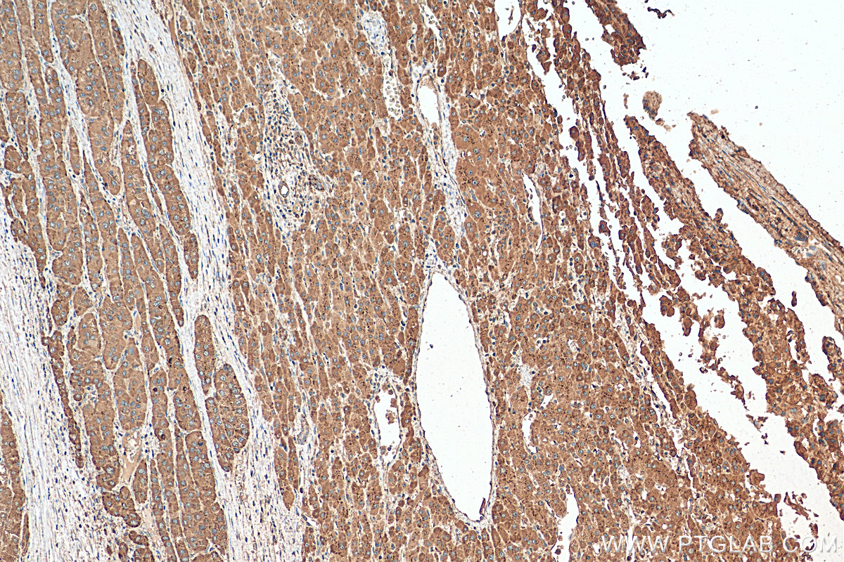 IHC staining of human liver cancer using 21997-1-AP