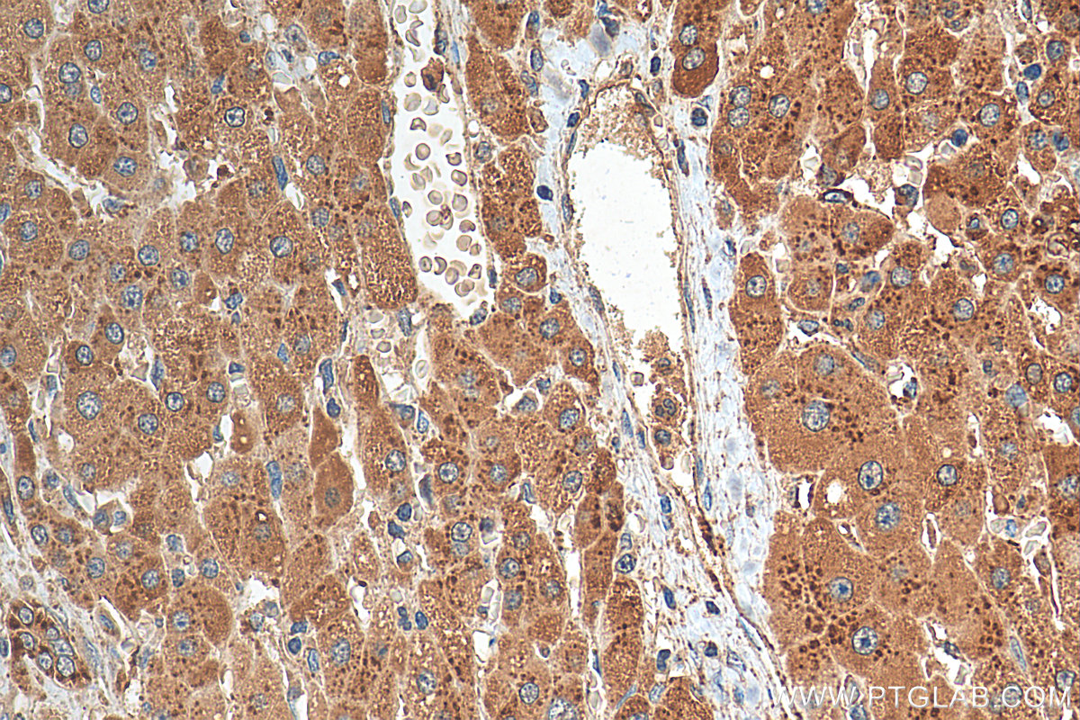 IHC staining of human liver cancer using 21997-1-AP