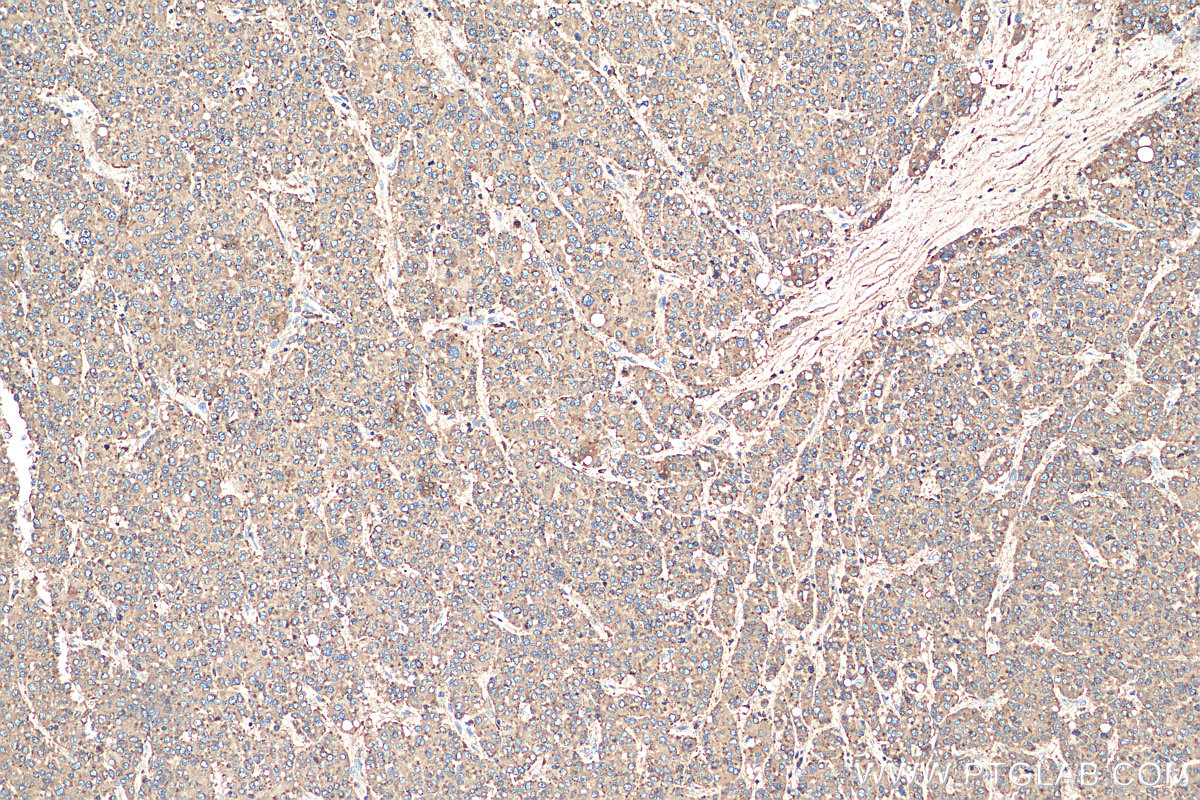 IHC staining of human liver cancer using 21997-1-AP