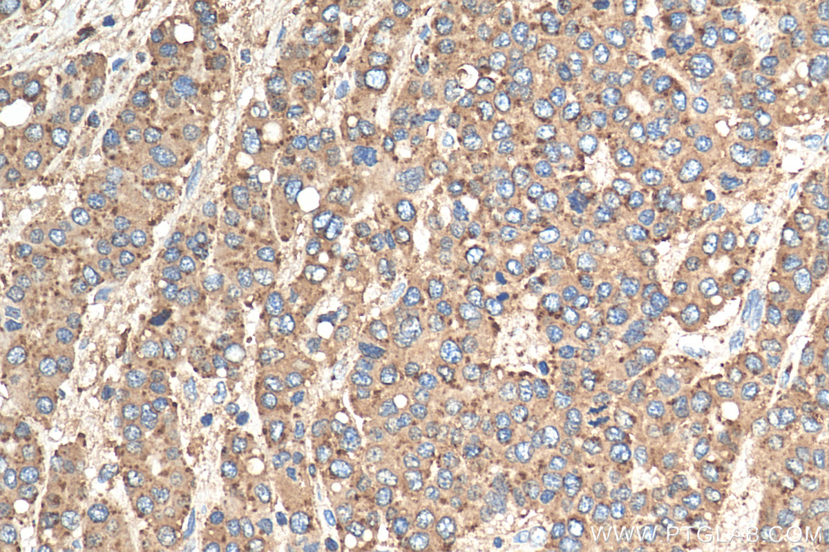 IHC staining of human liver cancer using 21997-1-AP