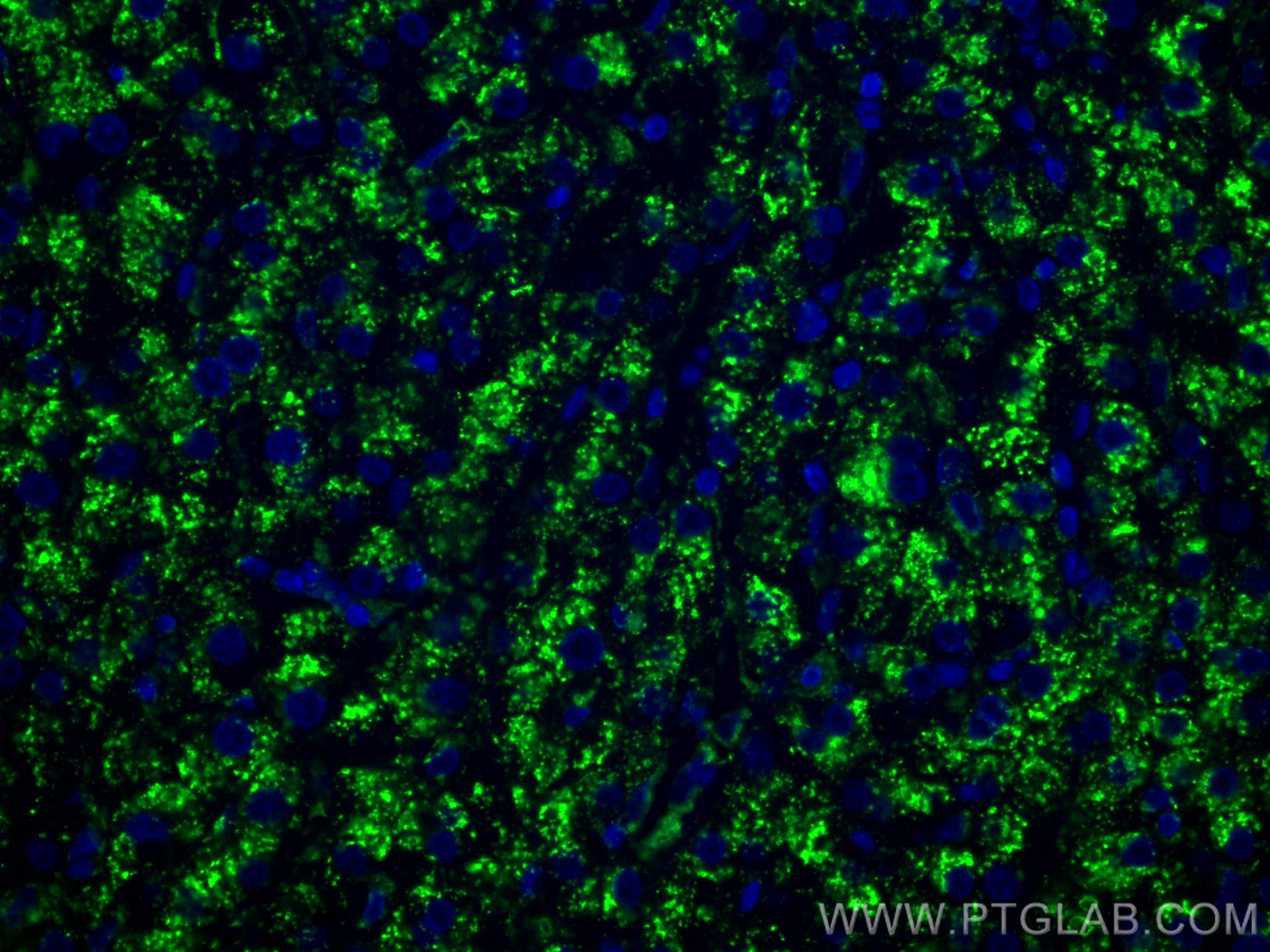 IF Staining of human liver cancer using 67300-1-Ig (same clone as 67300-1-PBS)