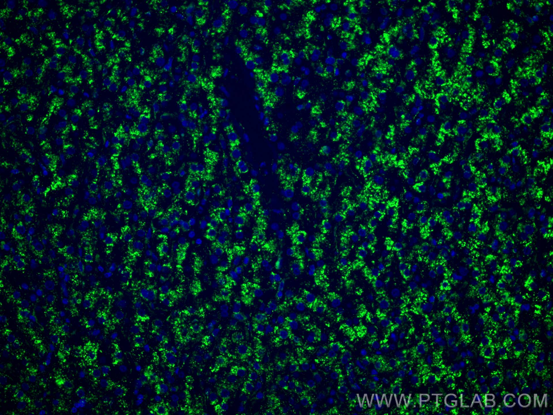 IF Staining of human liver cancer using 67300-1-Ig