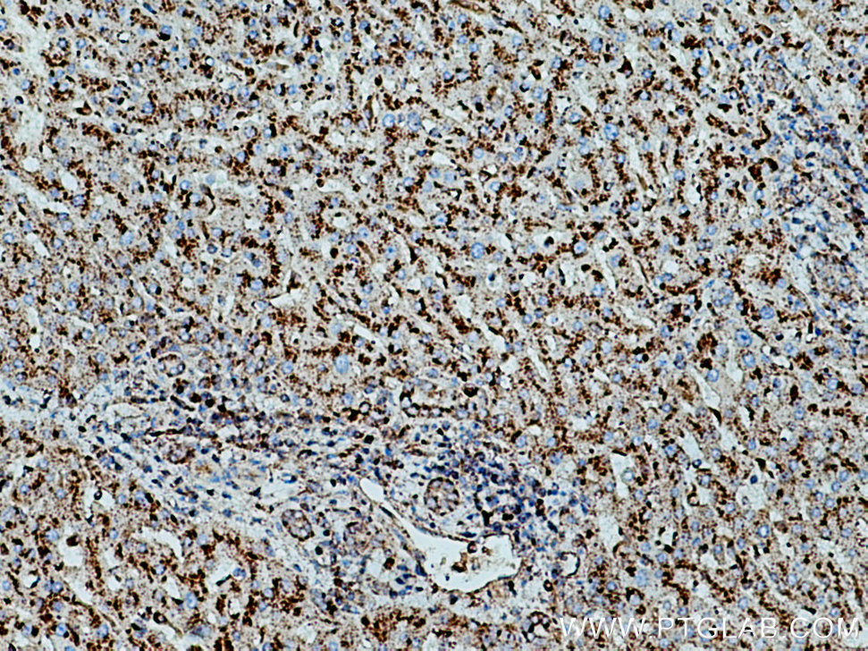 IHC staining of human liver cancer using 67300-1-Ig